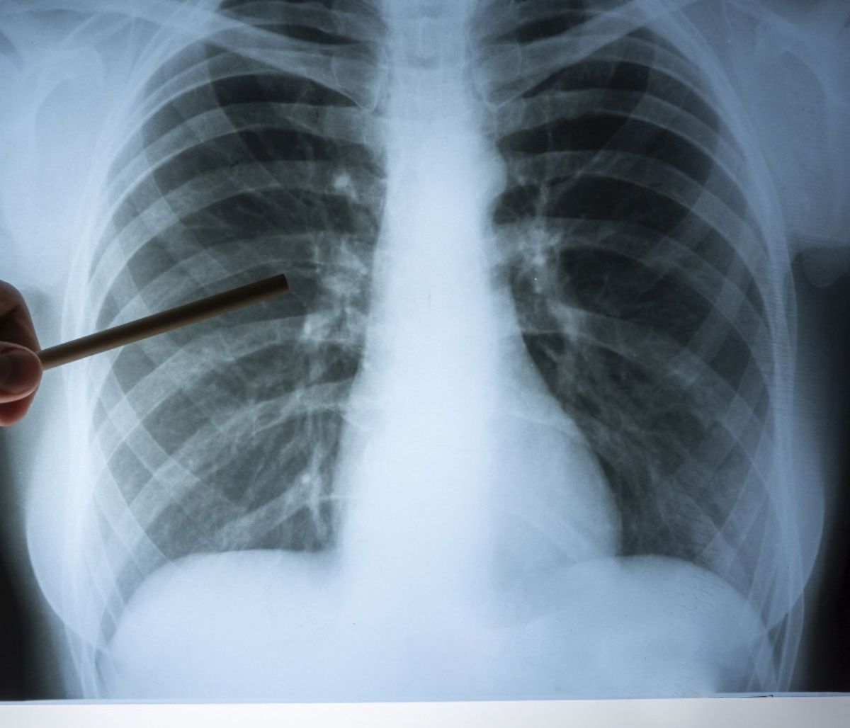 Τι είναι η κυστική ίνωση - Ποιοι οι διαθέσιμοι τρόποι αντιμετώπισης