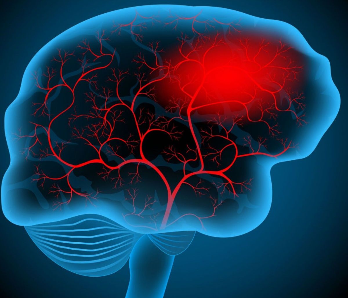 Εγκεφαλικό: Οι παράγοντες που αυξάνουν τον κίνδυνο