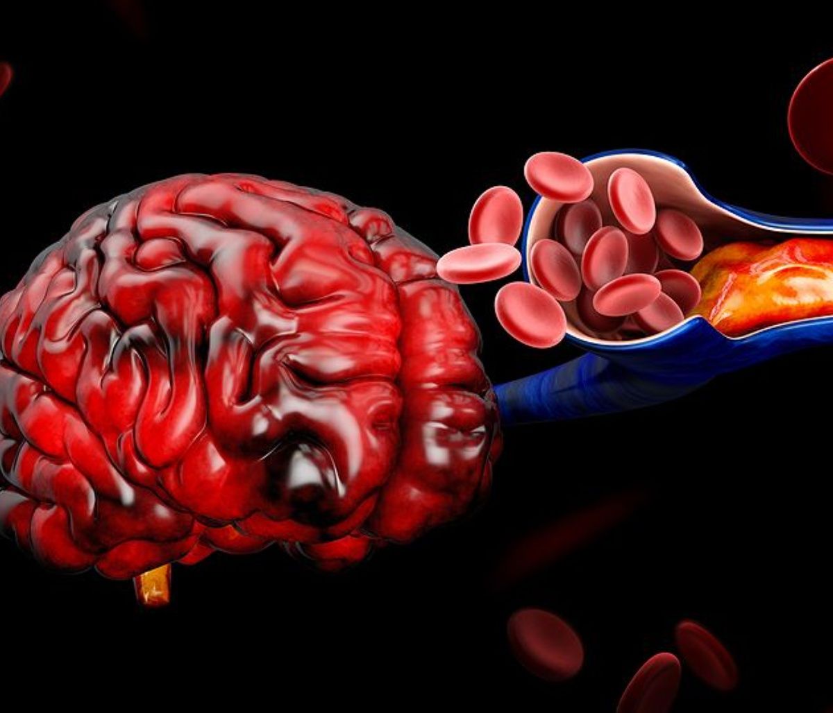 Θρόμβωση: Ποιοι άνθρωποι αντιμετωπίζουν πολλαπλάσιο κίνδυνο