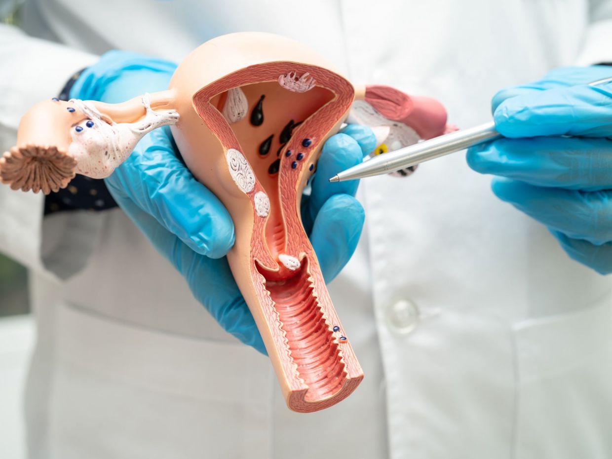 Ινομυώματα μήτρας: Αιτίες, συμπτώματα και σύγχρονες θεραπευτικές επιλογές