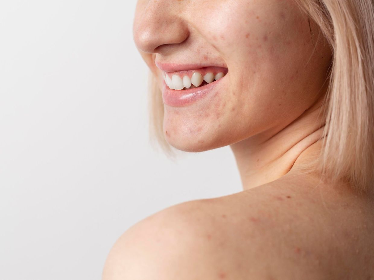 Φροντίδα ακμής: H σύγχρονη ρουτίνα που χαρίζει καθαρή και φωτεινή επιδερμίδα