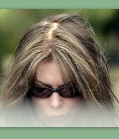 ΣΟΚ! Παραμορφώθηκε από τις πλαστικές και χάνει τα μαλλιά της!