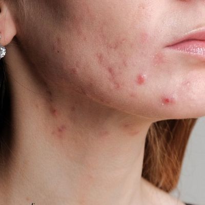 Period breakouts: Το δέρμα σου ξέρει ότι έρχεται περίοδος πριν από εσένα