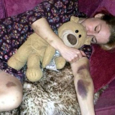 Αυτή η γυναίκα ξύπνησε και είδε το σώμα της καλυμμένο με μελανιές. Ο λόγος; Τρομακτικός!