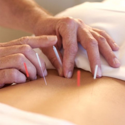 Βελονισμός: Σιλουέτα και καλή υγεία