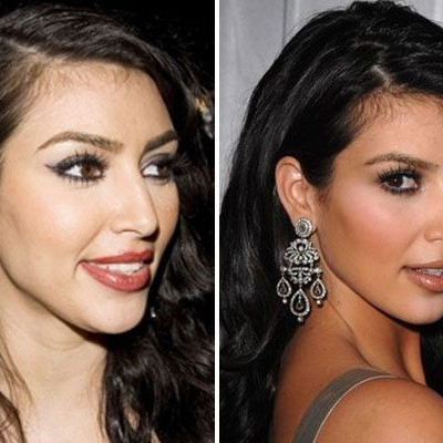 Οι πλαστικές επεμβάσεις της Kim Kardashian