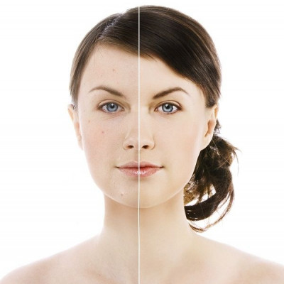 Το στρες προκαλεί την εμφάνιση της ακμής