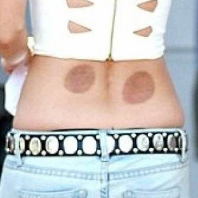 Ηθοποιός κυκλοφορεί δημόσια με σημάδια από… βεντούζες! (φωτό)