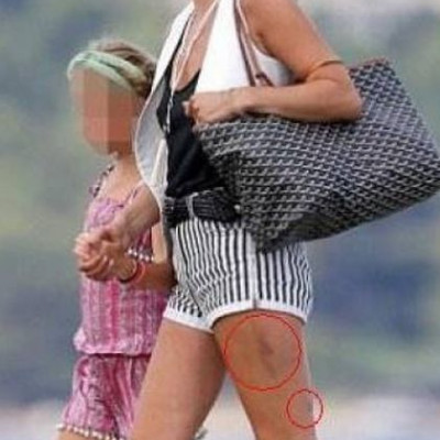 Πασίγνωστο μοντέλο εμφανίστηκε με μελανιές στα πόδια!