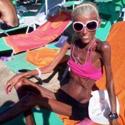 Ο αγώνας της Νανάς με την ανορεξία