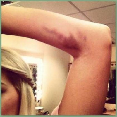 Ελληνίδα παρουσιάστρια με μελανιασμένο χέρι! Τι της συνέβη;