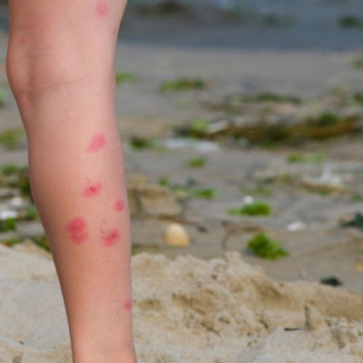 Η εποχή των κουνουπιών: Τι να κάνετε για να βγείτε νικητές στη μάχη του τσιμπήματος