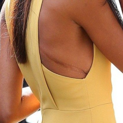 Ποια celebrity εμφανίστηκε με αυτή την τεράστια ουλή στην πλάτη;