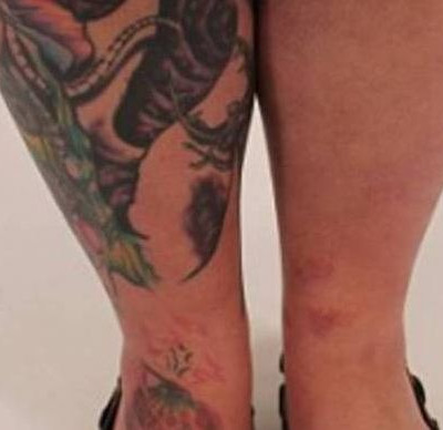 Κινδύνευσε να χάσει το πόδι της εξαιτίας ενός τατουάζ