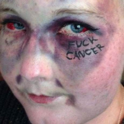 Βρετανία: Οι σοκαριστικές selfies – μήνυμα εναντίον του καρκίνου! (photos)