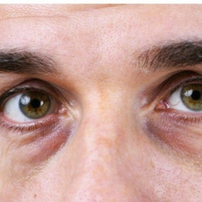 Τι να κάνετε για τους μαύρους κύκλους στα μάτια