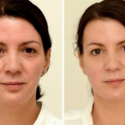 Έπινε 3lt νερό/ημέρα. Δείτε πόσο άλλαξε! (φωτογραφίες)