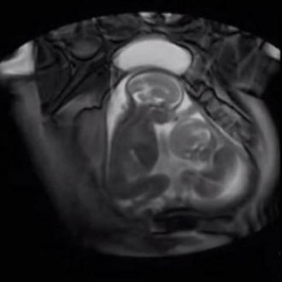 Δείτε δίδυμα μωρά να τσακώνονται μέσα στον πλακούντα. Ένα βίντεο που δεν έχετε ξαναδεί!