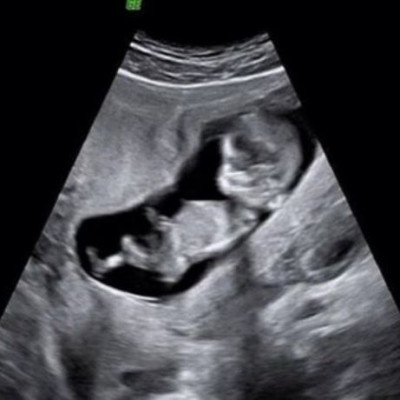 Πασίγνωστη Ελληνίδα ηθοποιός περιμένει το δεύτερο παιδί της & δείχνει το υπερηχογράφημα