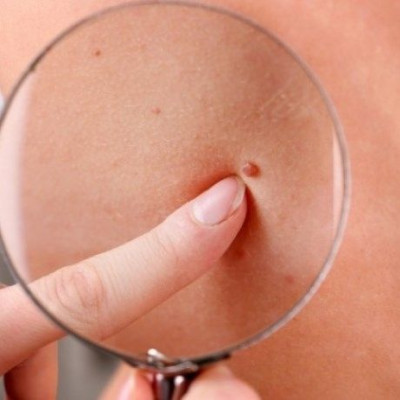 Τι σημαίνει για την υγεία ο αριθμός των ελιών στο σώμα - Δείτε αναλυτικά