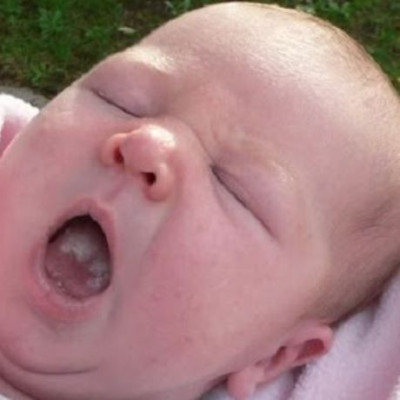 Στοματίτιδα στα παιδιά και πώς να την αντιμετωπίσετε