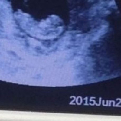 Ανατριχιαστική εικόνα: «Δαίμονας» σε υπέρηχο εμβρύου