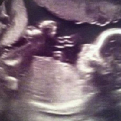 Πολύ τρυφερό! Υπέρηχος δείχνει έναν «άγγελο» να προσέχει την αγέννητη κόρη της (εικόνα)