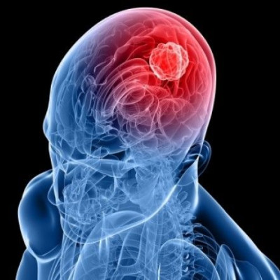 Καρκίνος εγκεφάλου: Τα ροφήματα που μειώνουν κατά 34% τον κίνδυνο