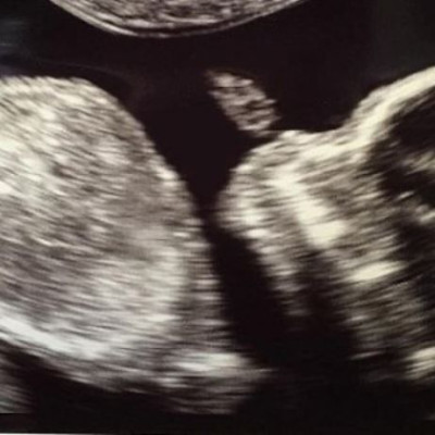 Ο πρώτος υπέρηχος του μωρού τους και το συγκινητικό μήνυμα στο Instagram!