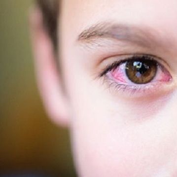 Συναγερμός στα σχολεία από τα κρούσματα εμφάνισης ψείρας στα βλέφαρα των παιδιών