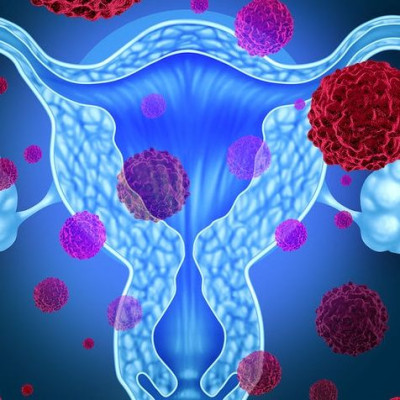 Καρκίνος ωοθηκών: Πώς θα μειώσετε κατά 31% τον κίνδυνο