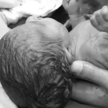 Η ομορφιά της γέννησης με τη νέα μέθοδο καισαρικής τομής (vid)