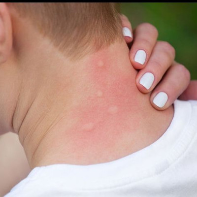 Συνταγή για κρέμα κατά των κουνουπιών με φυσικά υλικά