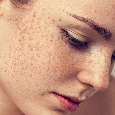 Γιατί εμφανίζεις πανάδες στο δέρμα σου; Μπορείς να τις εξαφανίσεις;