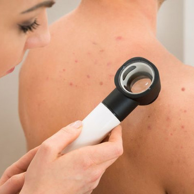 Σπυράκια στο μέτωπο, στο πιγούνι στην πλάτη – Τι δείχνουν σε κάθε περίπτωση