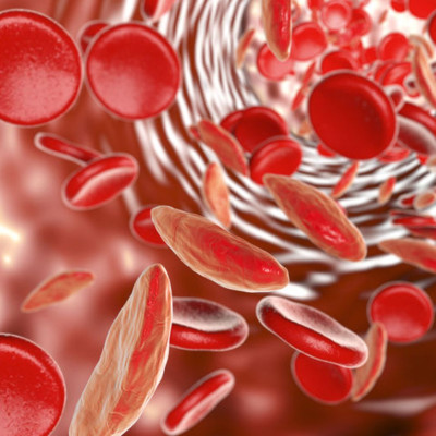 Αναιμία: 6 φρούτα που ενισχύουν την παραγωγή αιμοσφαιρίνης (φωτο)