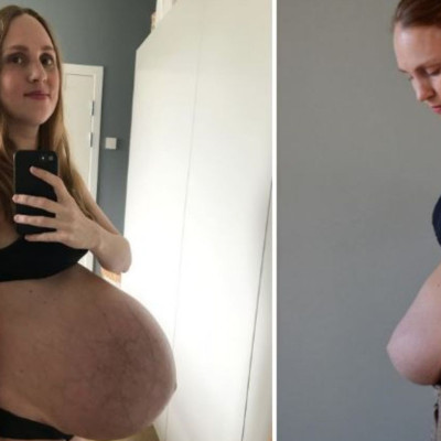 Γέννησε τρίδυμα και μας δείχνει το σώμα της πριν και μετά τη γέννα (pics)