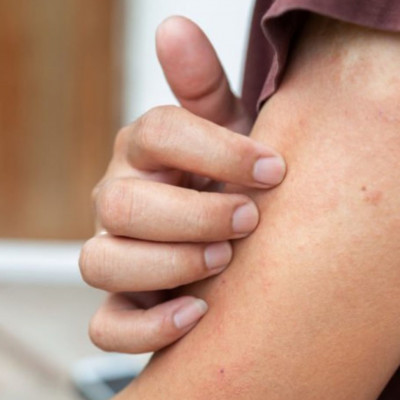 Έκζεμα: Το μπαχαρικό που βοηθά στην αντιμετώπιση της φαγούρας