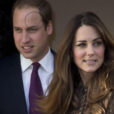 Τι ακριβώς ισχύει για την ουλή του Harry Potter στο πρόσωπο του πρίγκιπα William;