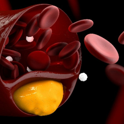 Οι χειρότερες τροφές για τη χοληστερόλη σας (pics)