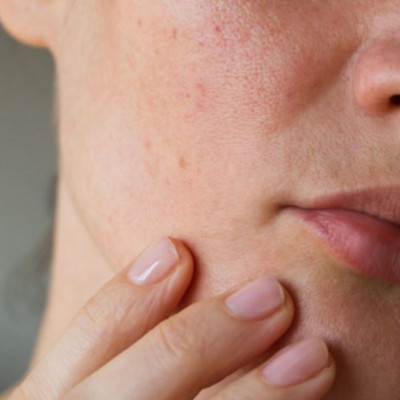 Ξηροδερμία τον χειμώνα: Οι 5 προτάσεις των ειδικών με φυσικά υλικά (pics)