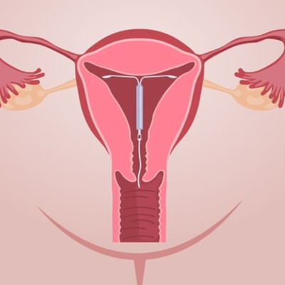 Ενδομήτριο σπείραμα & σεξ: Τι πρέπει να γνωρίζετε