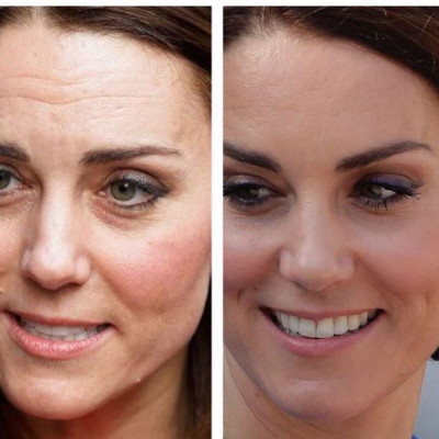 Η Kate Middleton έκανε botox αλλά ο γιατρός την ρεζίλεψε! Τι απαντά το Παλάτι στο σκάνδαλο;
