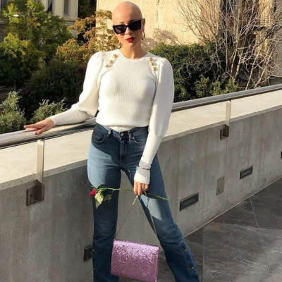 GNTM: Λυδία Κατσανικάκη: Δες το μοντέλο με την αλωπεκία με μακριά ξανθά μαλλιά και θα πάθεις πλάκα!