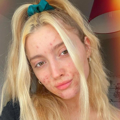 Έχεις δέρμα με ακμή; Μείνε μακριά από αυτές τις τροφές