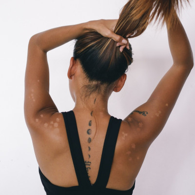 Χάνεις το μαύρισμα ή συμβαίνει κάτι άλλο; Τι είναι τελικά αυτά τα λευκά σημάδια στην πλάτη σου;