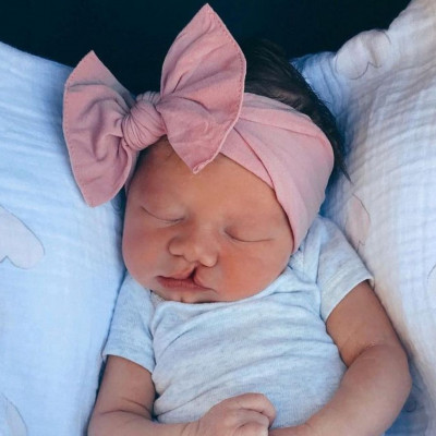 Λαγόχειλο και λυκόστομα (σχιστίες) - Η μικρή που τρέλανε το Instagram