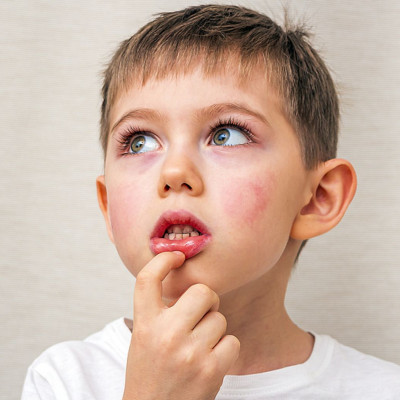 Δαγκώσατε ή κάψατε τη γλώσσα σας; Να τι να κάνετε