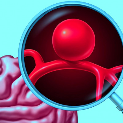 Ανεύρυσμα: Οι κύριες αιτίες ρήξης (εικόνες)