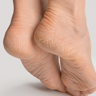 Σκληρύνσεις και κάλοι: Πώς θα απαλλαγείτε (video)